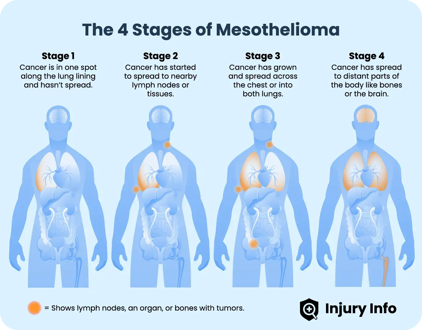 The four stages of mesothelioma illustrated.