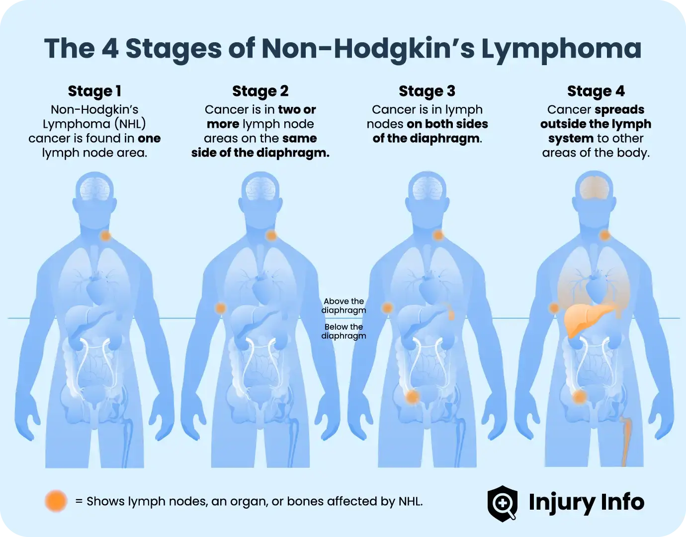 Non-Hodgkin lymphoma staging.