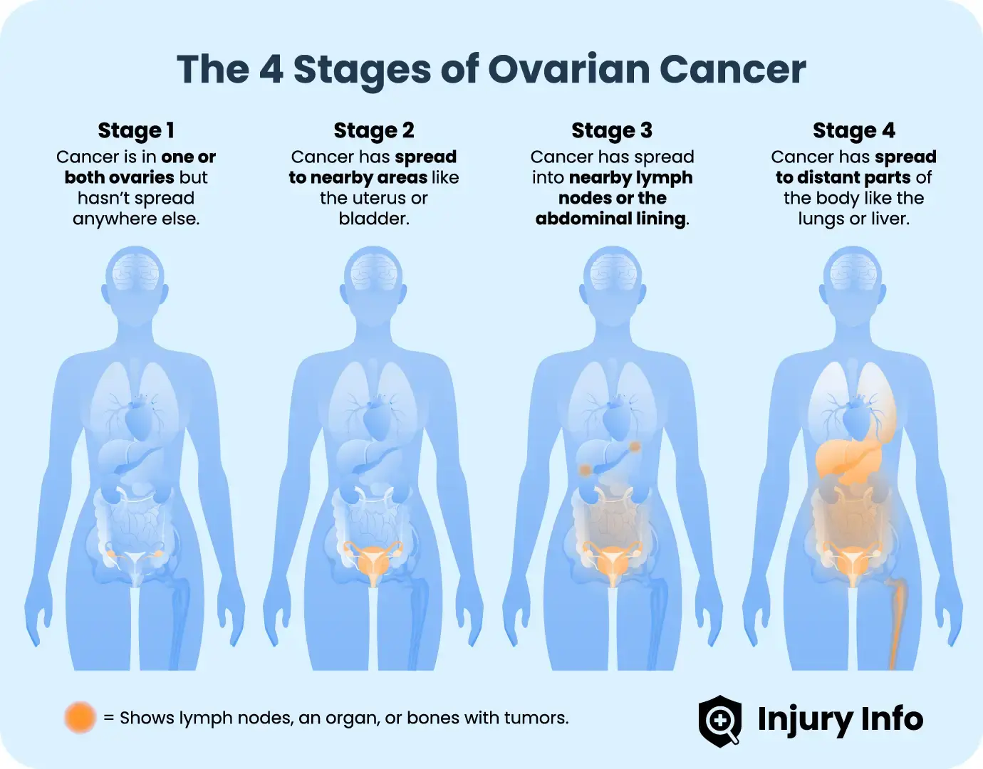 Ovarian cancer stages.